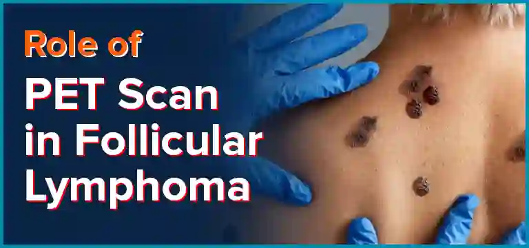 Role of PET scan in Follicular lymphoma: Uses, Preparation, Procedure, & Cost